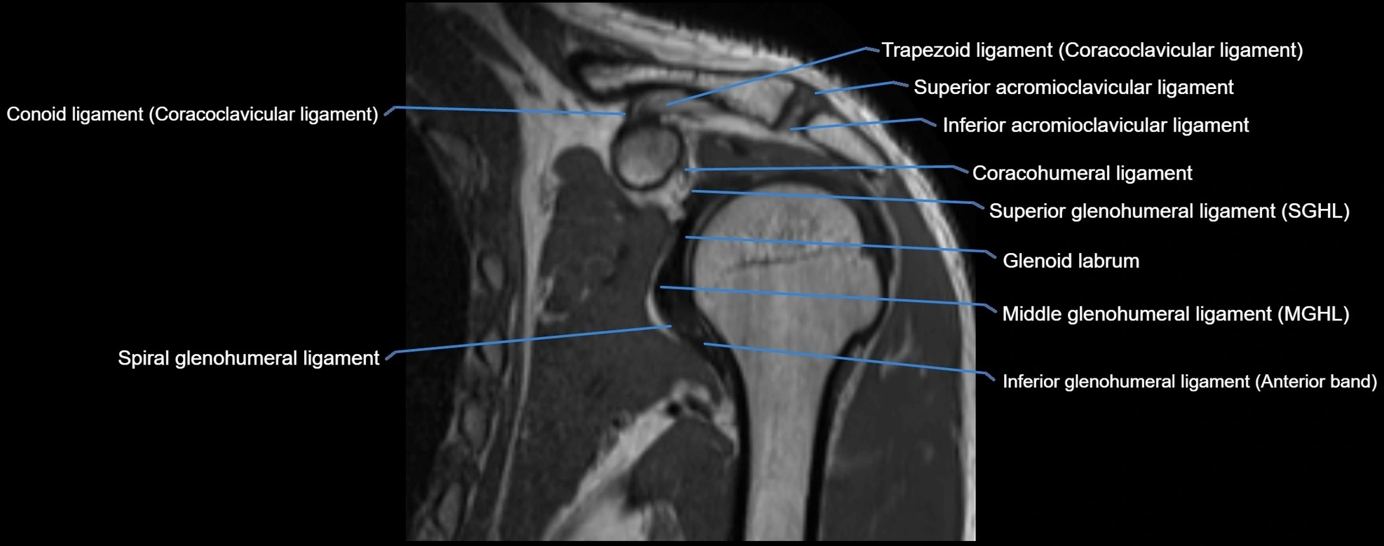 shoulder ligments coronal  cross sectional anatomy 3T MRI AI enhanced radiology image -img-00001-00022.webp